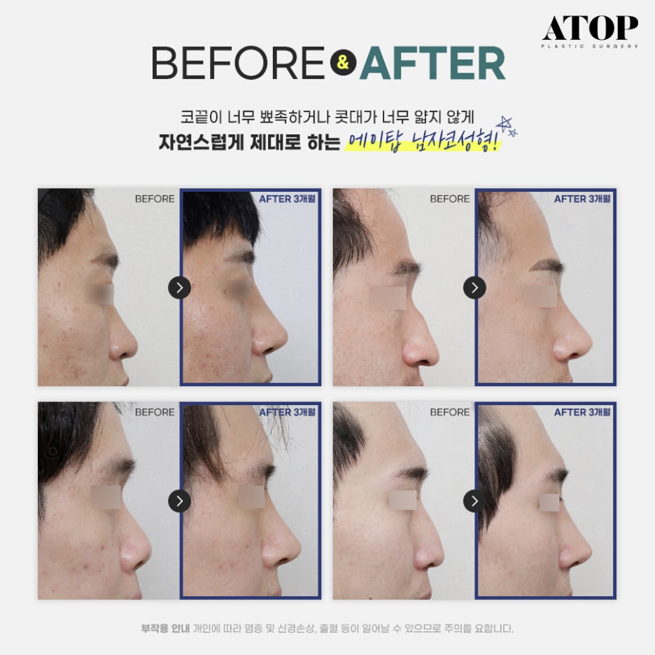Male Nose Surgery Review: A Natural Line That Doesn’t Look Artificial image 7