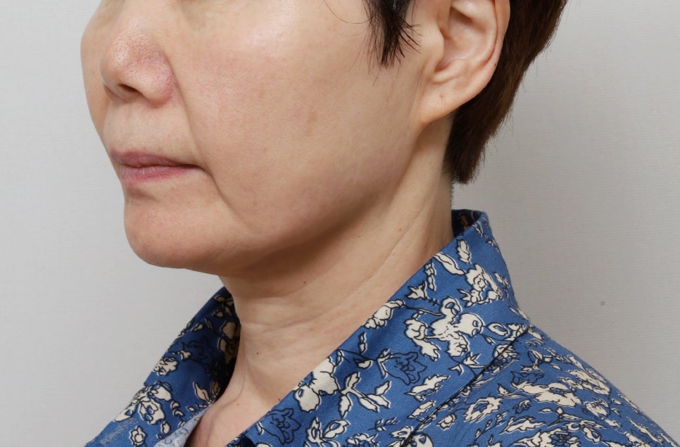 Facial rejuvenation surgery in the 60s [deep plane facelift revision] - A case of improving nasolabial folds, the midface, and jowls image 2
