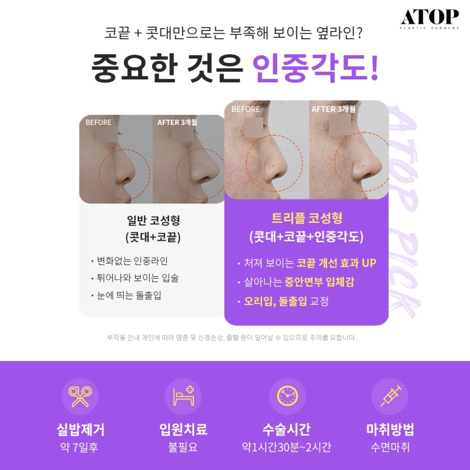 매부리코수술후기 내게 맞는 코 모양을 찾아 관련 이미지 3