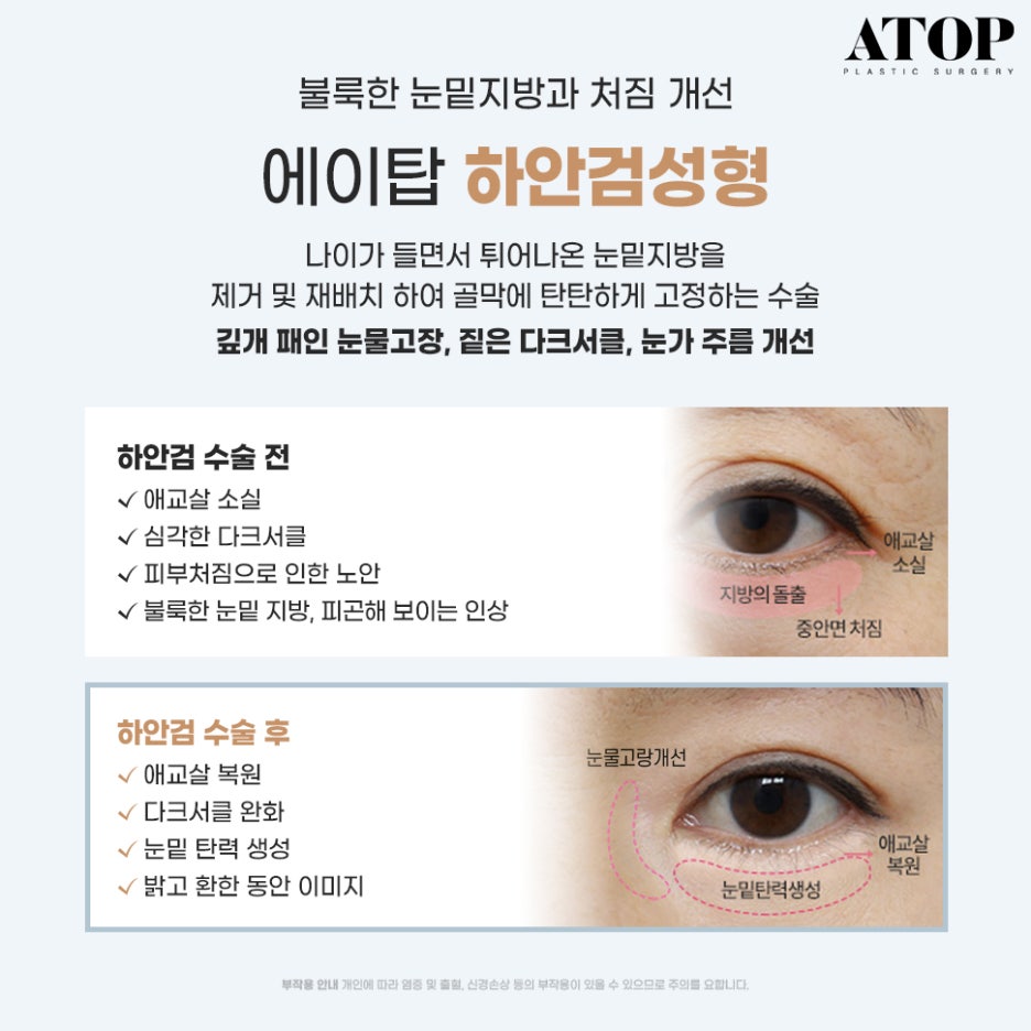 눈밑하안검수술 눈밑처짐까지 고민된다면? 관련 이미지 5