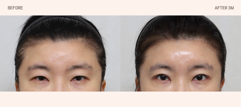 The 5-Point Incisions Remain the Same, but the Dissection Planes Are Different｜Second-Generation Dual-Plane Forehead Lift image 2