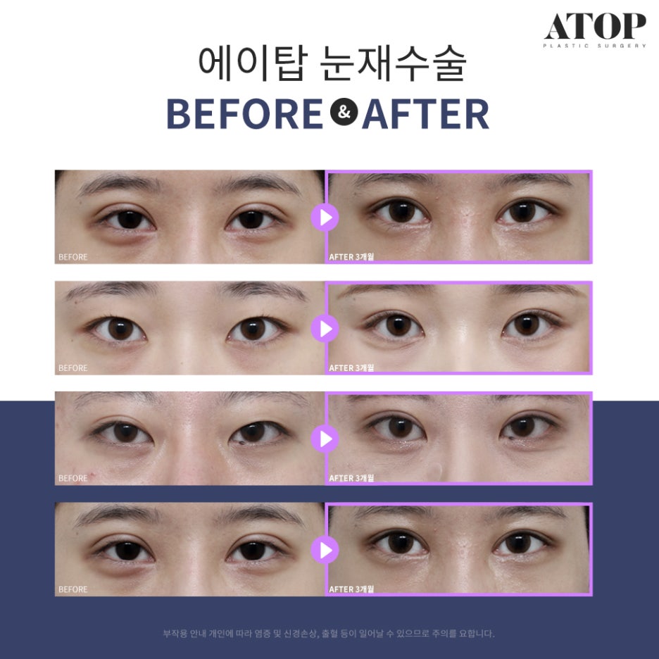 Double Eyelid Revision Surgery Review: No More Repeated Problems image 7