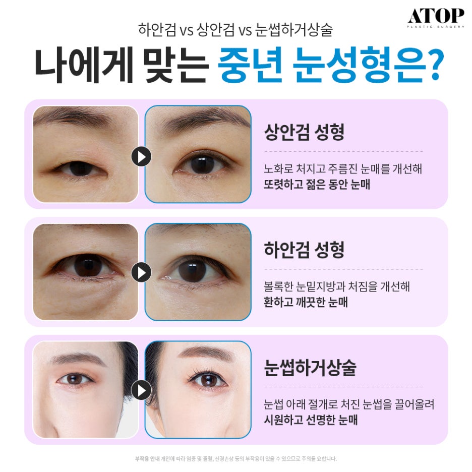 처진눈수술 중년의 눈을 또렷하게 관련 이미지 3