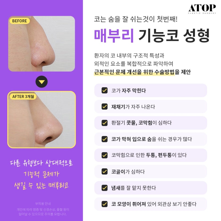 매부리코수술후기 내게 맞는 코 모양을 찾아 관련 이미지 5
