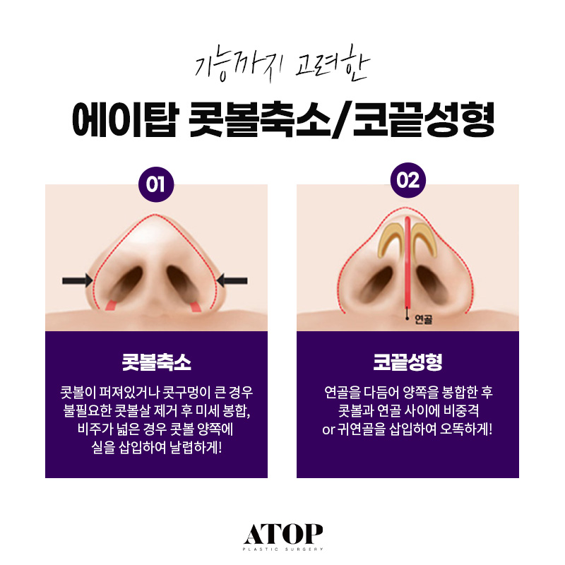 콧볼축소수술방법 원인을 먼저 파악해야 하는 이유 관련 이미지 1