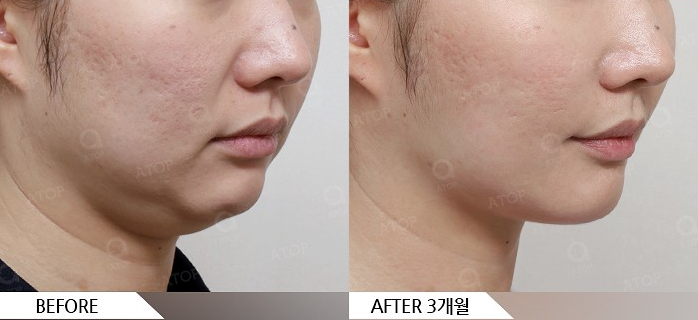 Mini Facelift Lifting That Also Improves Nasolabial Folds: Upgraded Yeo-woo Lifting image 3