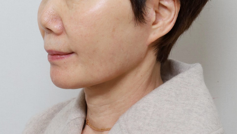 Facial rejuvenation surgery in the 60s [deep plane facelift revision] - A case of improving nasolabial folds, the midface, and jowls image 5