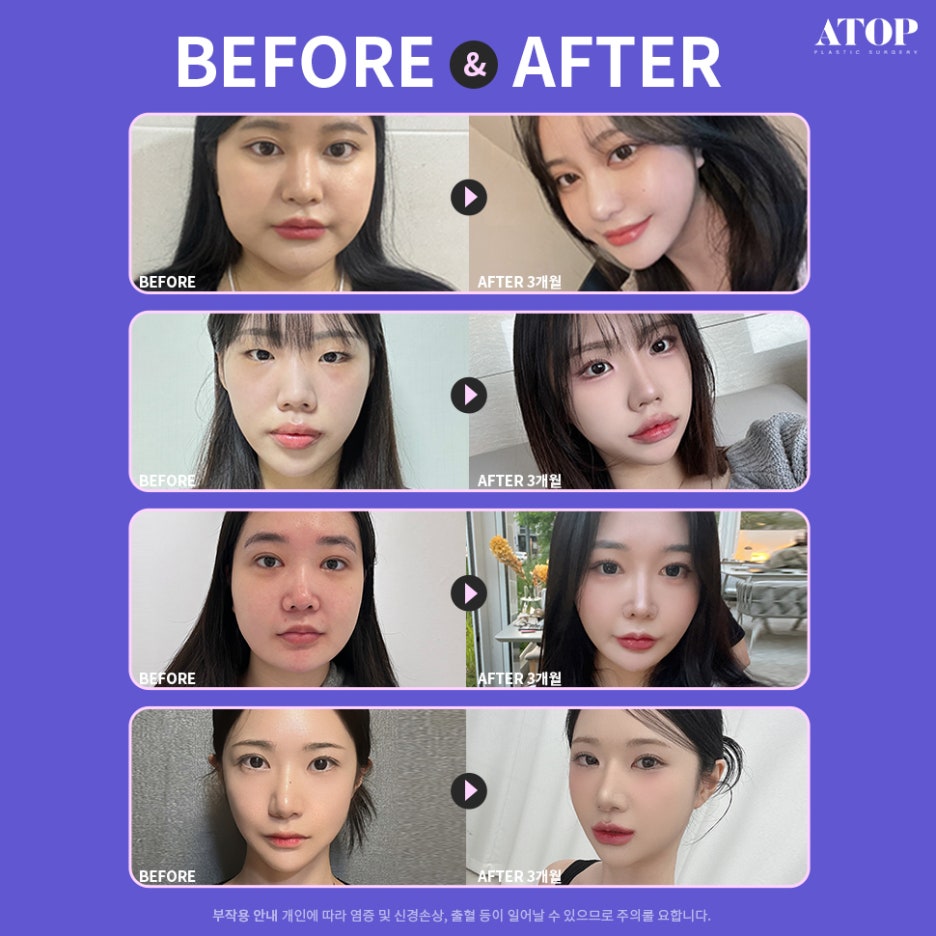 연예인성형외과 이목구비부터 얼굴형까지 부드러운 개선 관련 이미지 7
