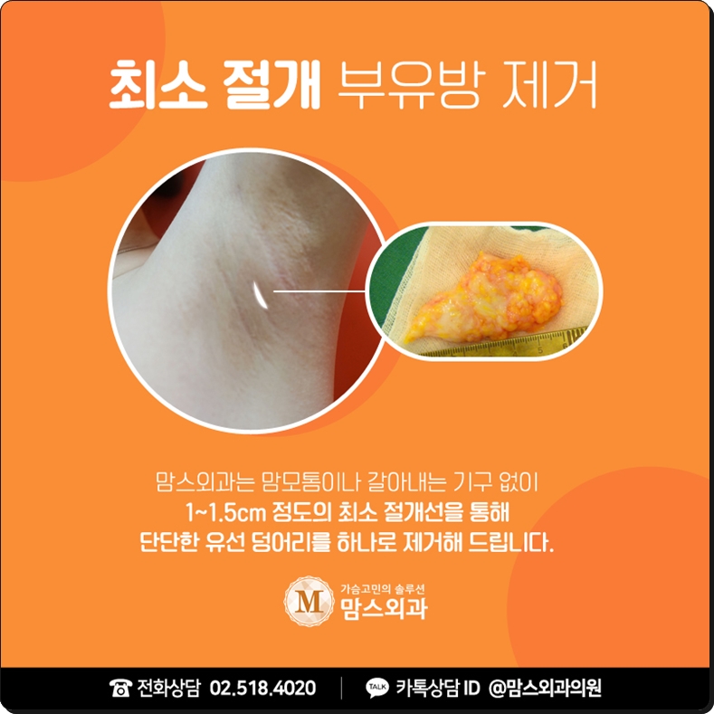 부유방수술비용 포인트는 무엇일까? 관련 이미지 5