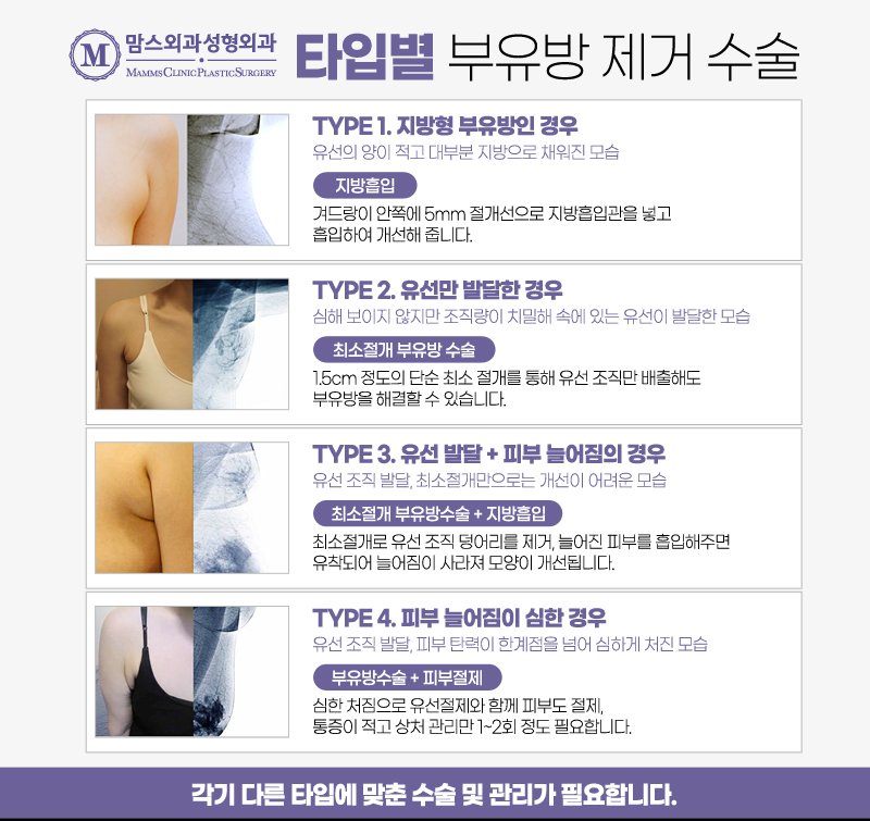 겨드랑이지방흡입 유형별 개선 방법 알아보기! 관련 이미지 2