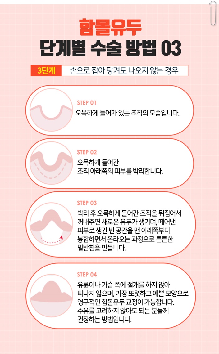 함몰유두교정 답을 찾으세요? 관련 이미지 11