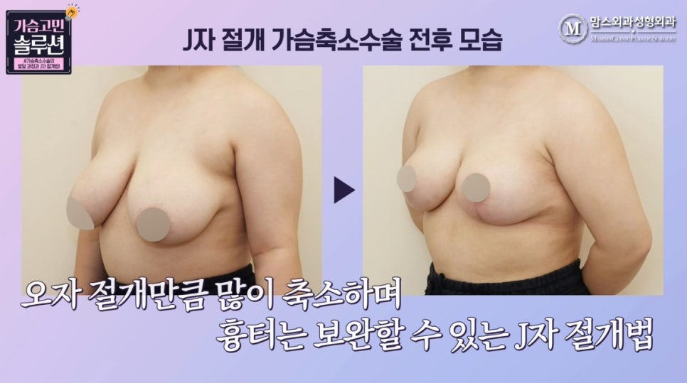 Looking at the J-Shaped Incision Method for Breast Reduction with Photos! image 16