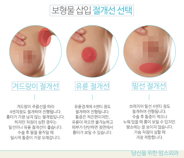 가슴확대술 내몸인데신경써야죠 관련 이미지 3
