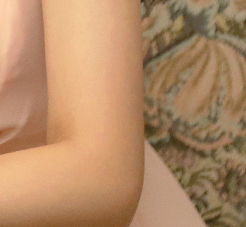 겨드랑이몽우리 라인부터 재발까지 생각하는 솔루션! 관련 이미지 22