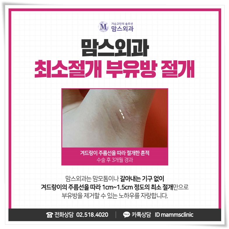 부유방제거로 삶의 질을 위해 관련 이미지 6
