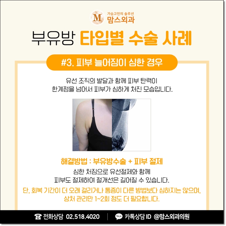 겨드랑이지방흡입 고려한다면 관련 이미지 7