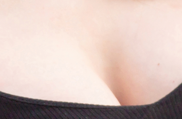 겨드랑이지방흡입 부유방제거는 병원과 전문의 선택이 정말 중요합니다 관련 이미지 19