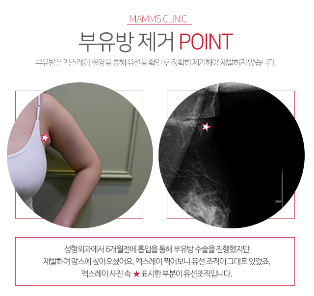 겨드랑이 혹 걱정도떼어버리자 관련 이미지 4