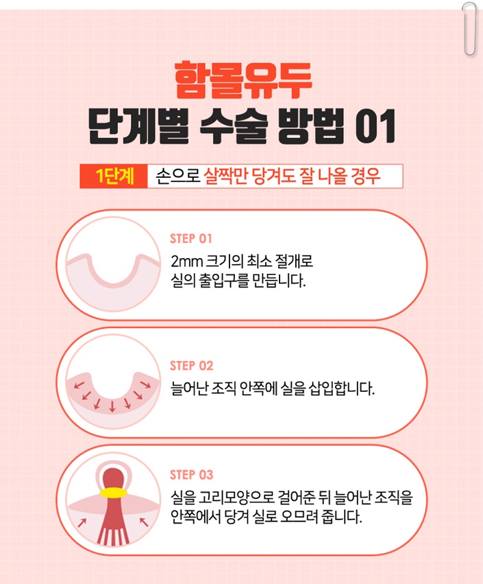 함몰유두교정 답을 찾으세요? 관련 이미지 9