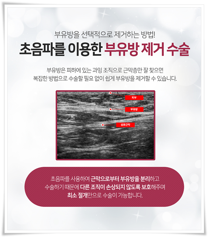 부유방수술 평소에 신경이 쓰였다면 관련 이미지 7