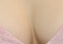 겨드랑이볼록 부유방 덜어내고 편안한 일상으로! 관련 이미지 20