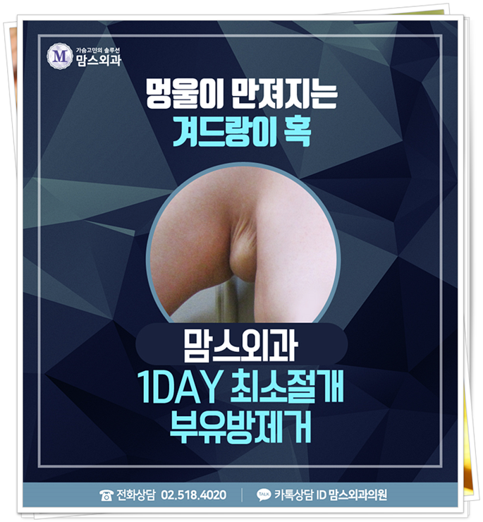 겨드랑이멍울 시선이 신경 쓰이죠 관련 이미지 1