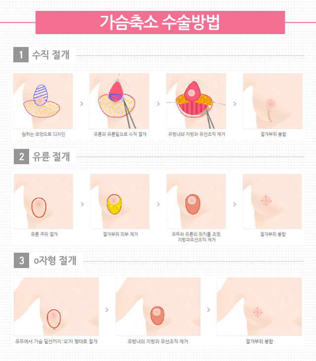 가슴축소수술 건강을위한 필수조건 관련 이미지 4