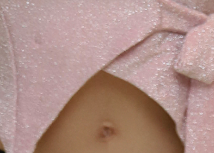 겨드랑이살 볼륨 줄이고 슬림한 라인을 원한다면? 관련 이미지 23