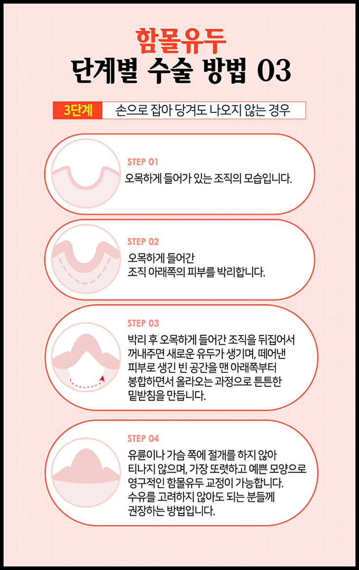 함몰유두수술비용 올바른 선택을 위해서는? 관련 이미지 7