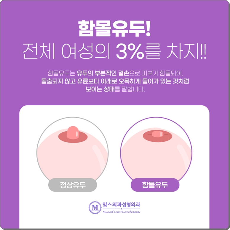 함몰유두교정 수술도 주의 깊게 살펴보면 관련 이미지 2