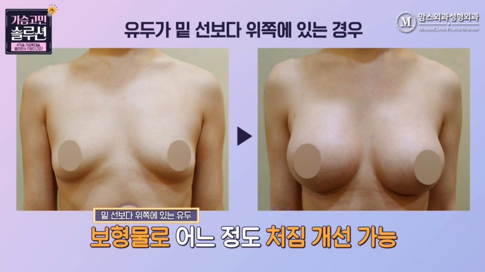 가슴 거상확대술, 줄이면서 키운다고요? 관련 이미지 7