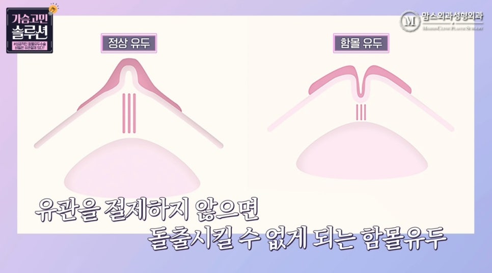 함몰유두수술의 성공을 위한 포인트는? 관련 이미지 6
