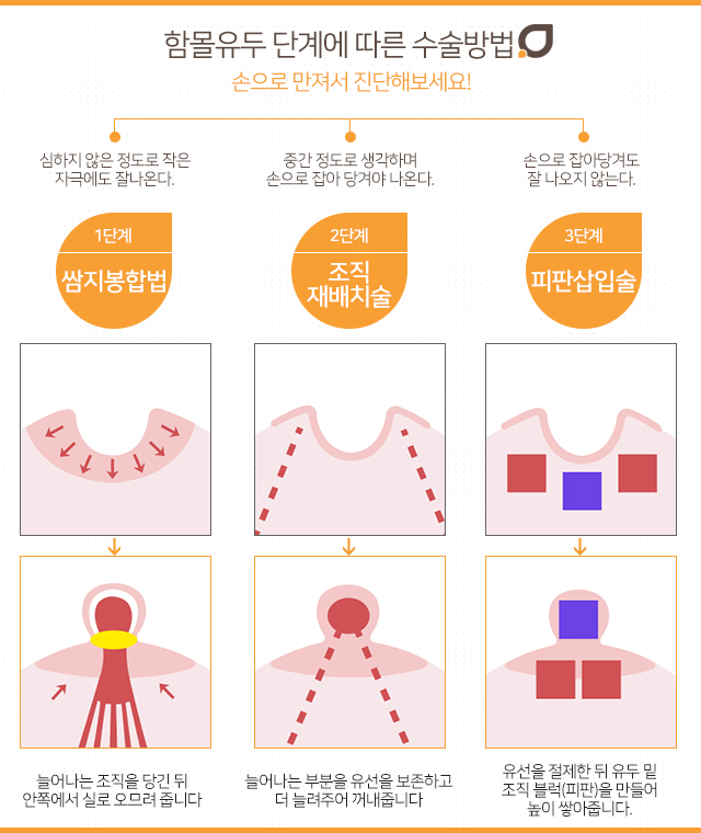 함몰유두치료 단계별방법 관련 이미지 2