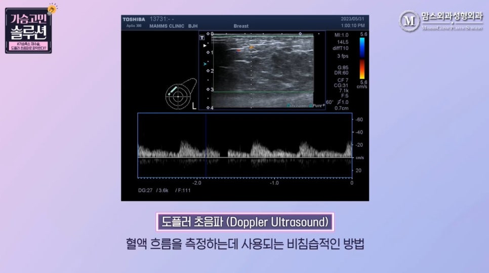 How Can Breast Reduction Revision Surgery Be Checked with Doppler Ultrasound? image 4