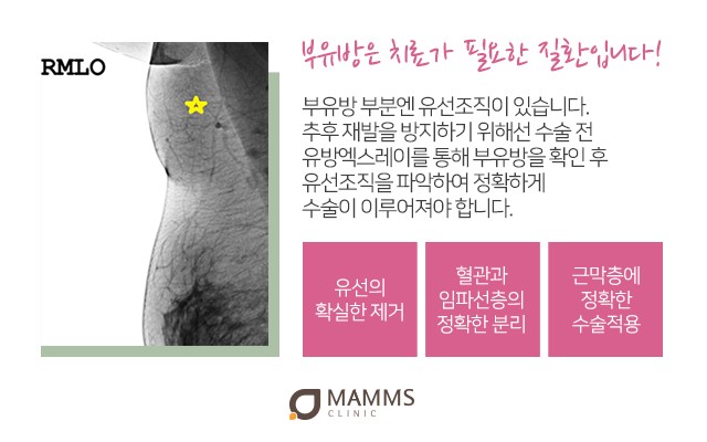 겨드랑이 혹 단단하게만져지나요? 관련 이미지 3