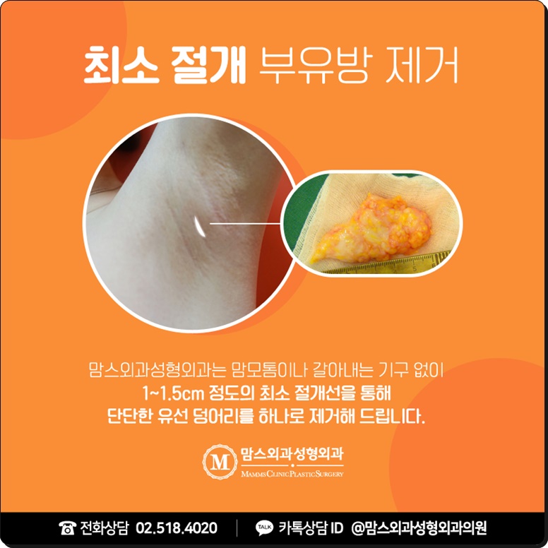 겨드랑이멍울을 떼어낼 방법을 찾고 있나요? 관련 이미지 5