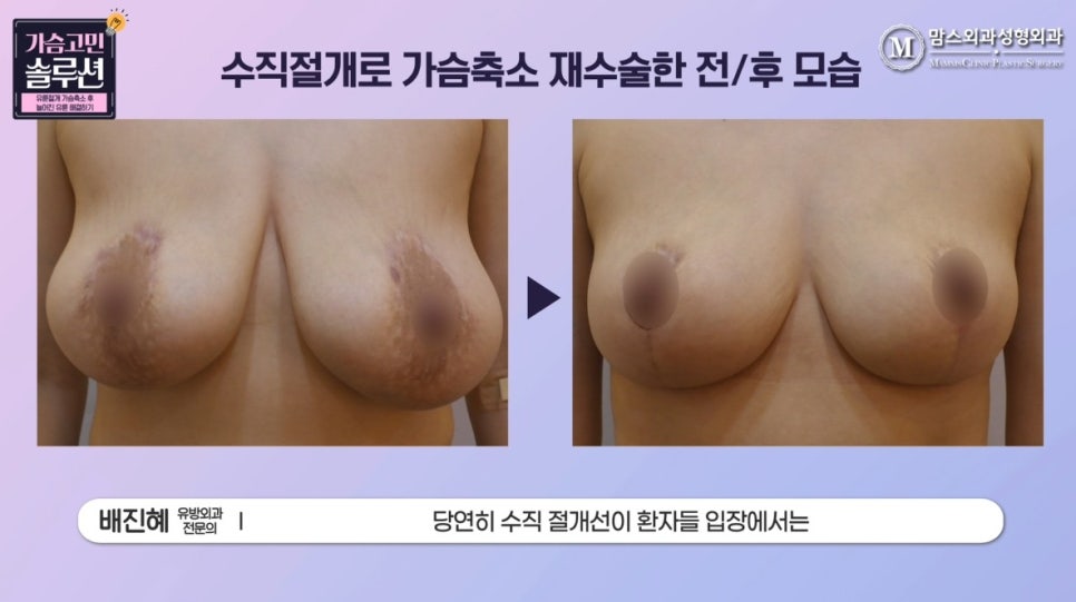가슴축소재수술 실제 사례, 늘어진 유륜 개선하기! 관련 이미지 5