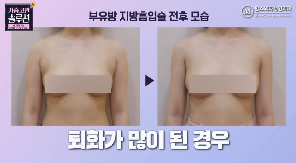 부유방제거수술 유형별 수술 방법은? 관련 이미지 7