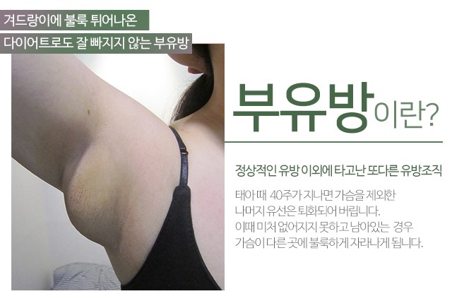 부유방지방흡입 유선제거를 확인하세요 관련 이미지 2