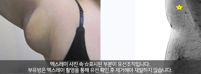 겨드랑이혹 너무걱정마세요 관련 이미지 3