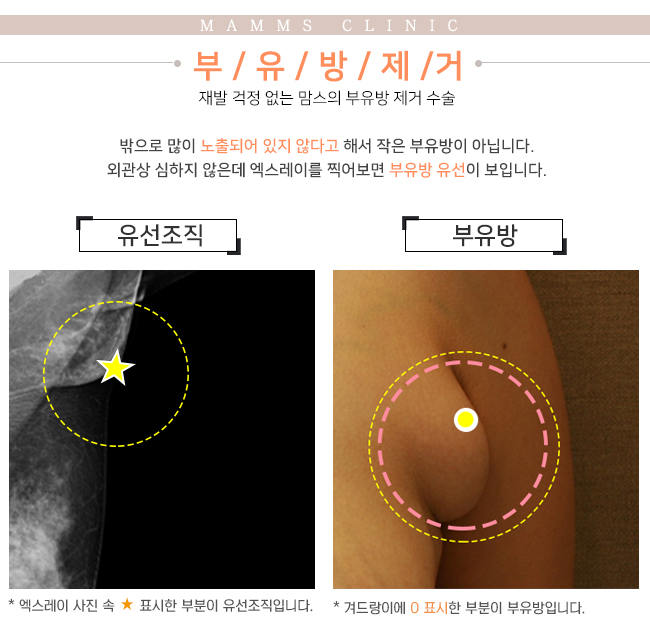 겨드랑이살 제거방법 관련 이미지 3