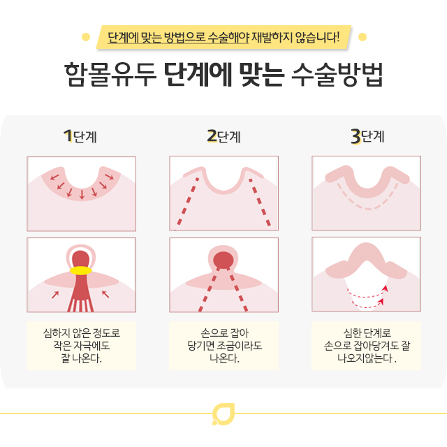 함몰유두수술부작용 적합한 수술 방법은? 관련 이미지 3