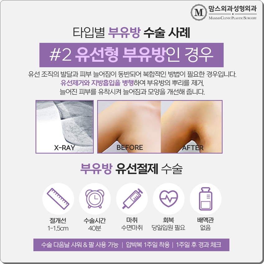 부유방제거수술 내게 맞는 것으로 관련 이미지 7