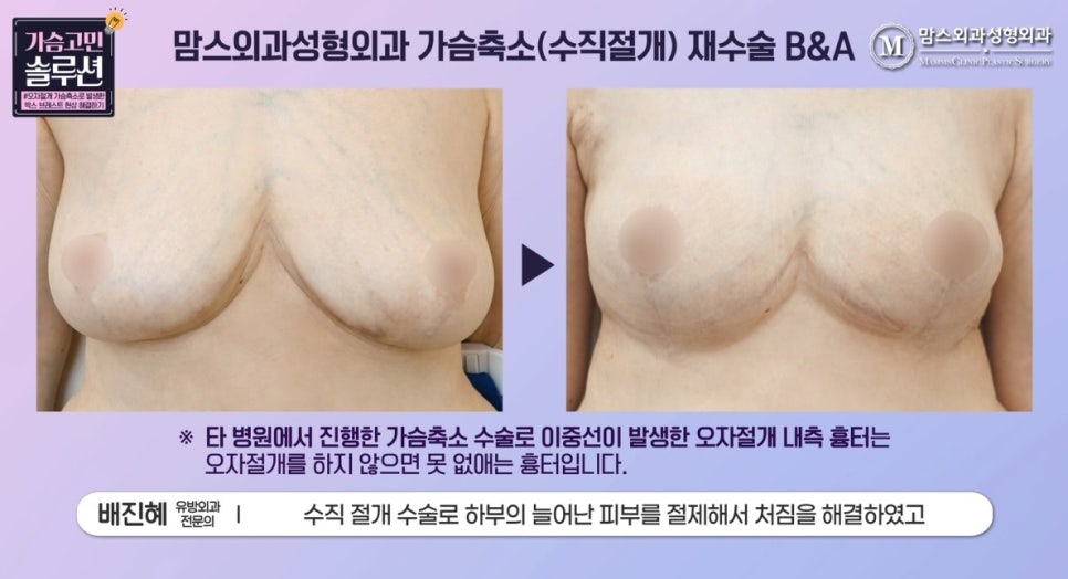 Can breast reduction revision surgery be done with a vertical incision after an inverted-T incision? image 6