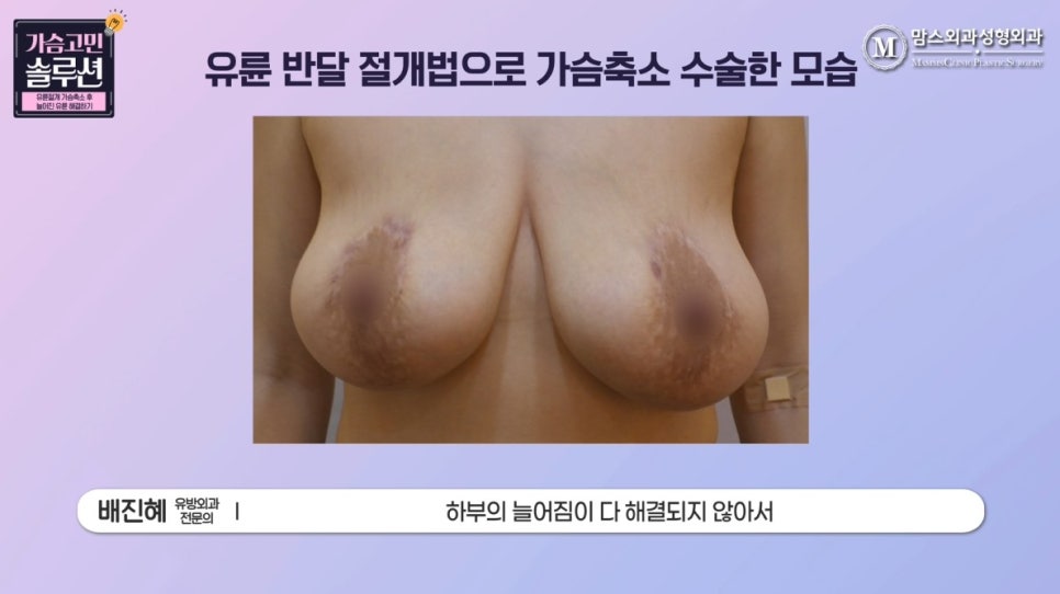 가슴축소재수술 실제 사례, 늘어진 유륜 개선하기! 관련 이미지 2