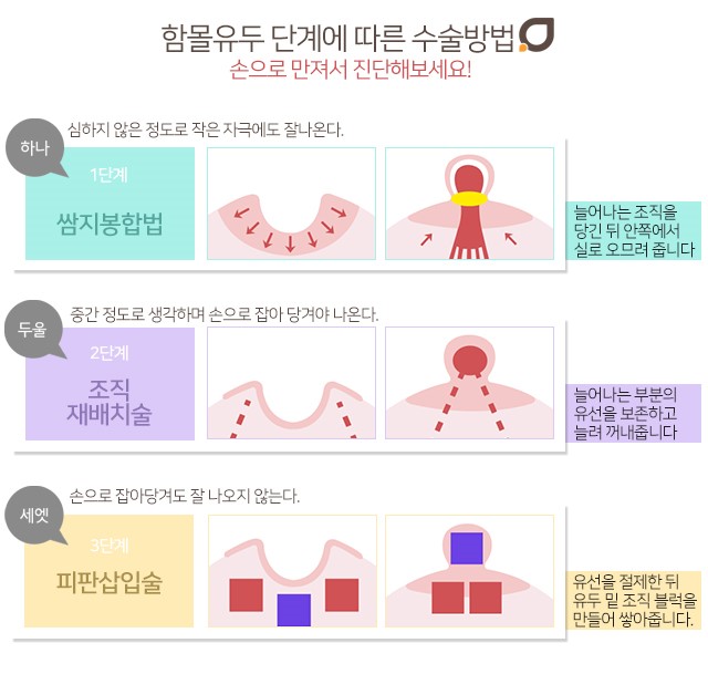 함몰유두재수술 걱정없이해야죠 관련 이미지 3