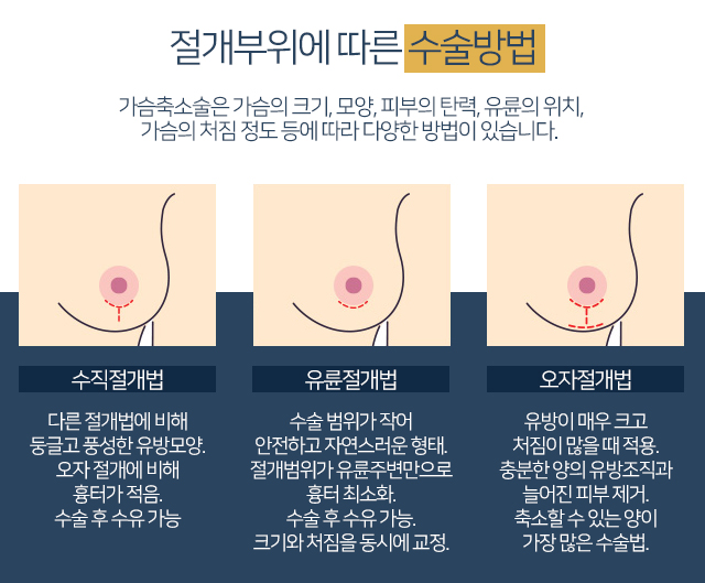 가슴처짐수술 안전하게아름답게 관련 이미지 4