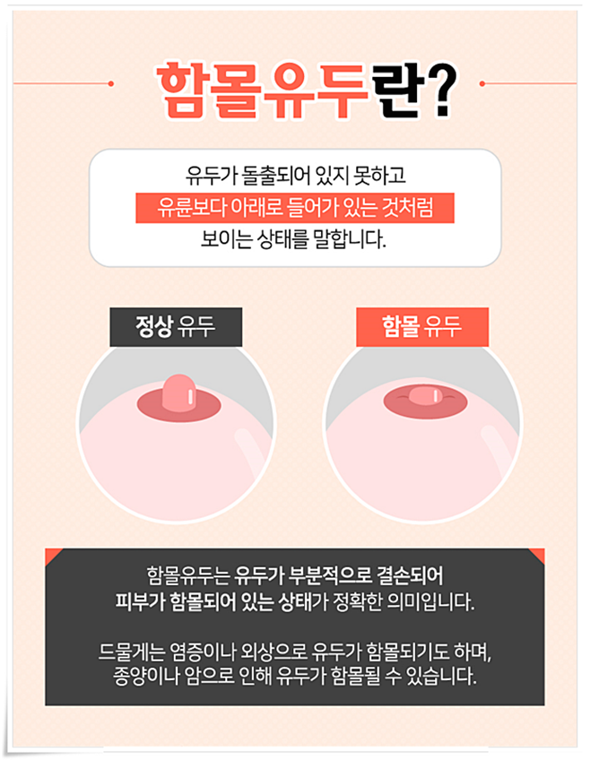 함몰유두 원인 아직까지 몰랐었지 관련 이미지 2