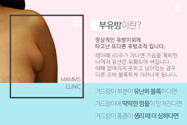 부유방수술비용 크기에상관없어요 관련 이미지 2