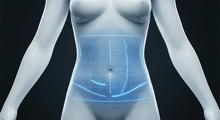 Realistic Criteria You Should Know Before Consulting About Abdominoplasty Costs image 15